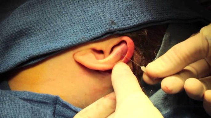 Cirugía en orejas grandes