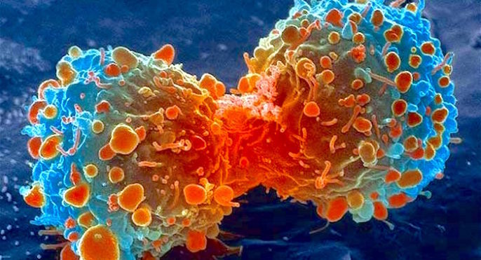 ¿Existe una cura para el cáncer de mieloma?