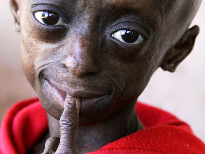 ¿Existe una cura para la progeria?
