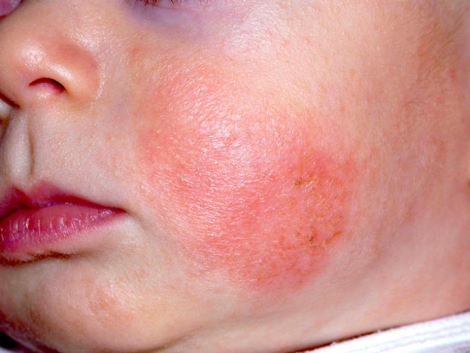 Eczema en niños pequeños