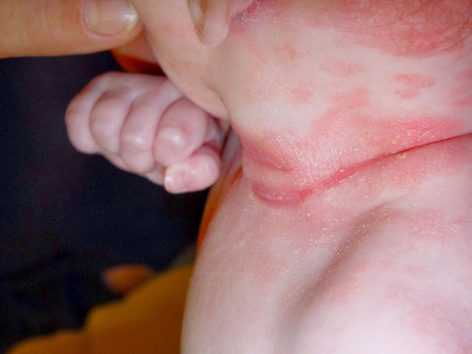 Eczema en niños y curas naturales