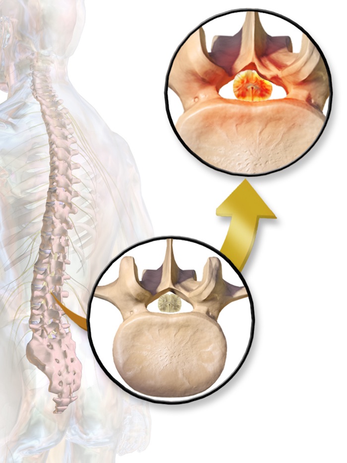 Cirugía para estenosis espinal lumbar