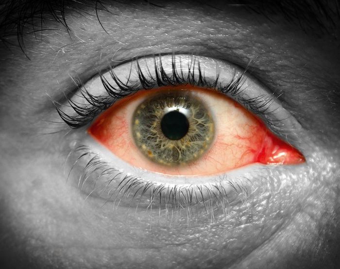 Prevención del ojo rosado