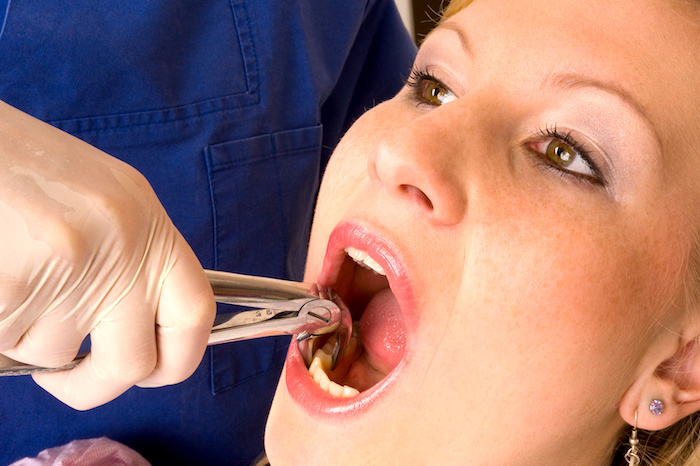 Complicaciones de la extraccion dental