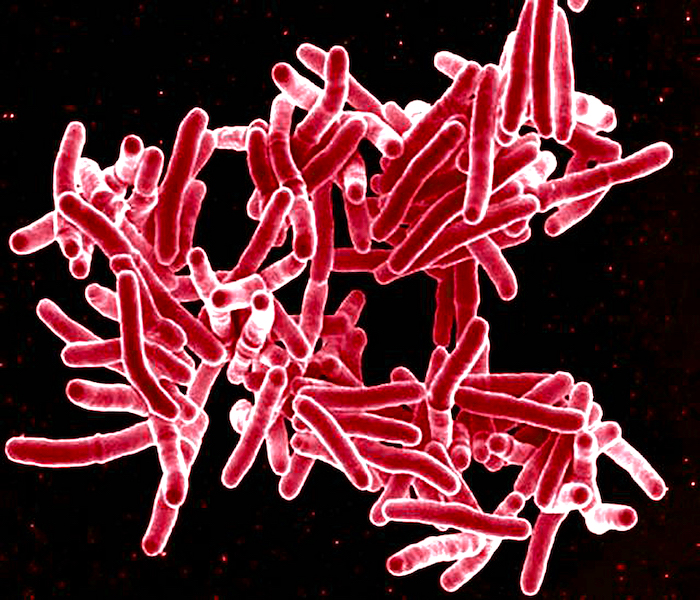 Complicaciones de la tuberculosis