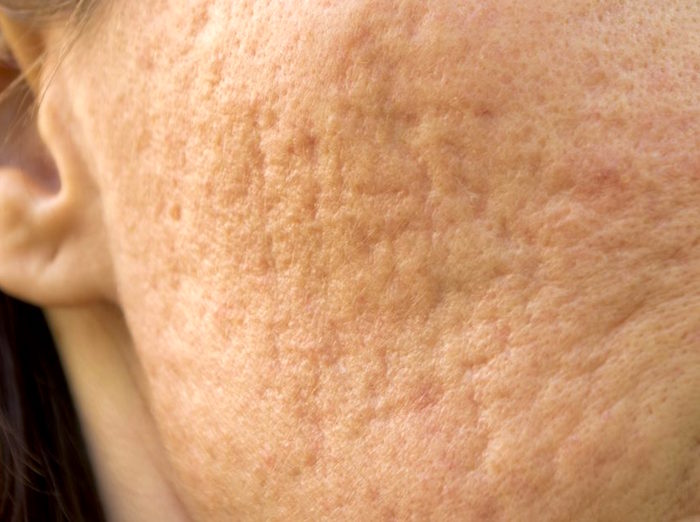 Consejos para eliminar cicatrices de acne