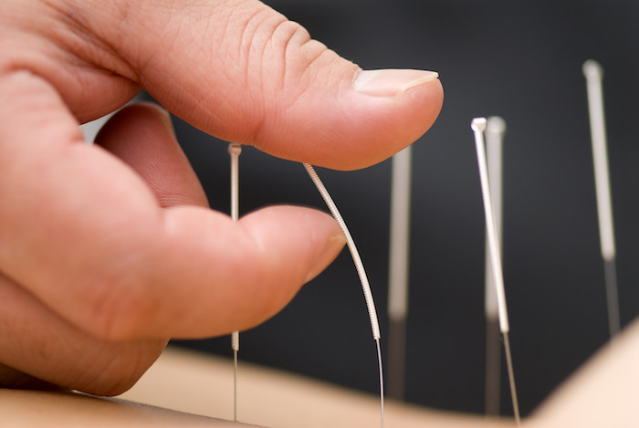 La acupuntura como una opción de pérdida de peso viable