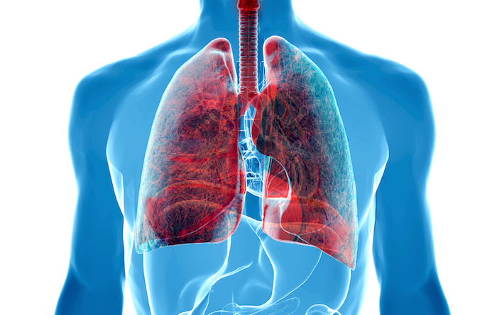 Complicaciones del cancer de pulmon