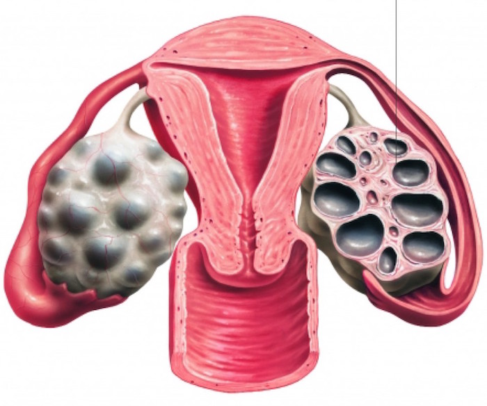 Complicaciones del sindrome de ovario poliquistico