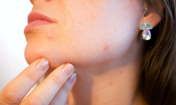 Los mejores suplementos para el acne
