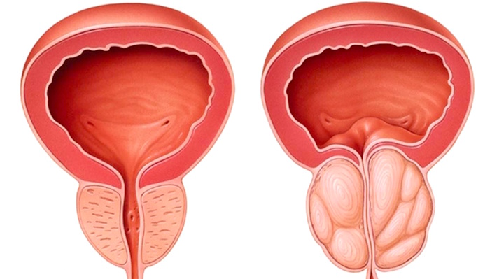 Cirugia para prostata agrandada