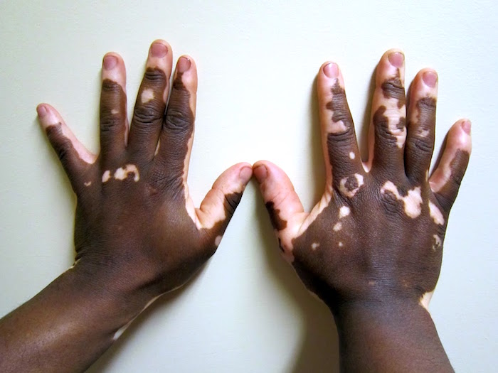 Remedio homeopático para el vitiligo