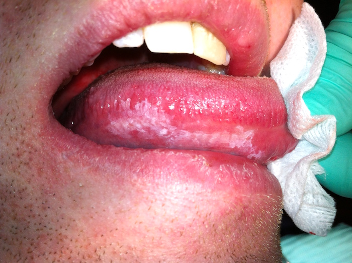 Cirugía para el cáncer de lengua