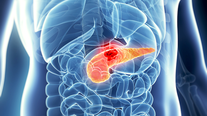 Causas del cáncer de páncreas