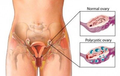 El Remedio mediante alimentos para el síndrome de ovario poliquístico