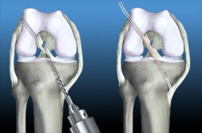 Ligamento cruzado anterior, complicaciones de la cirugía
