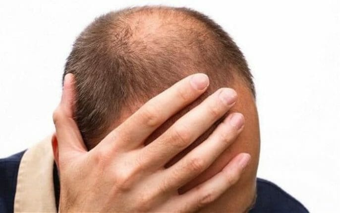 ¿Quedándose calvo? Opciones de recrecimiento del cabello para los hombres con calvicie