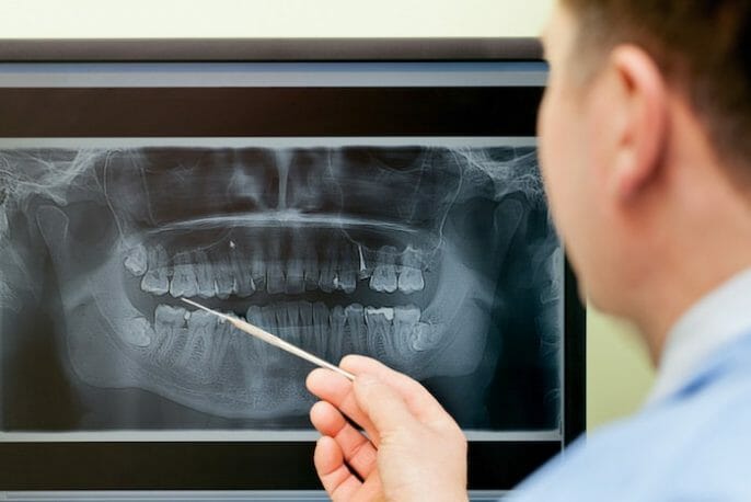 ¿Por qué puede necesitar una operación sinusal si quiere implantes dentales?