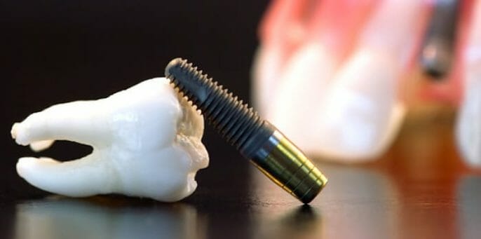 ¿Cómo saber si su implante dental está fallando y qué hacer al respecto?