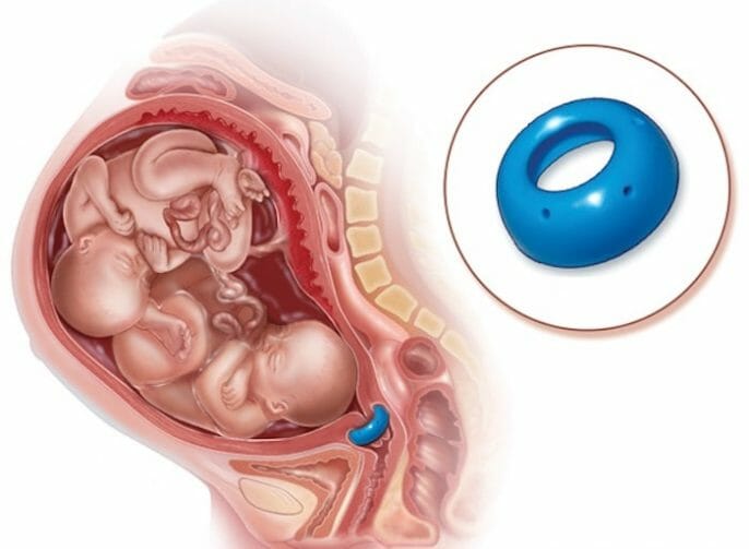 ¿Qué es un cuello uterino incompetente durante el embarazo?