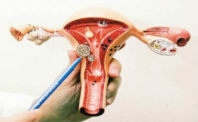 ¿Puede causar infertilidad los fibromas uterinos?