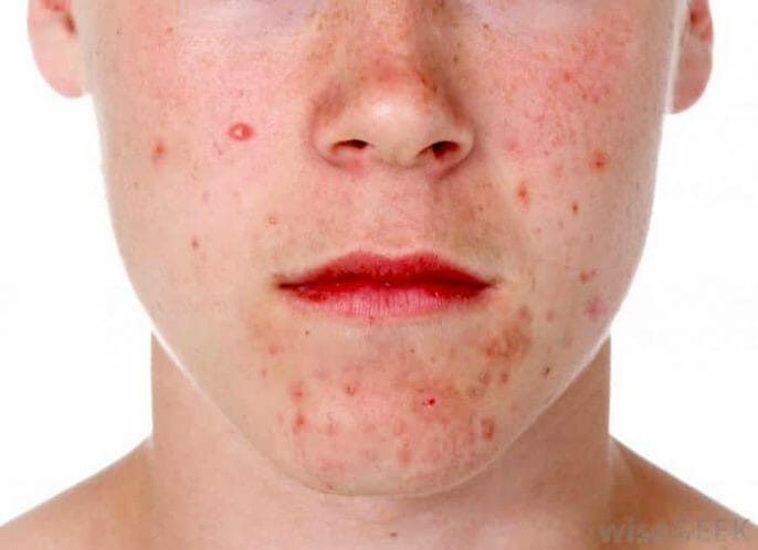Reacción alérgica al tratamiento del acné