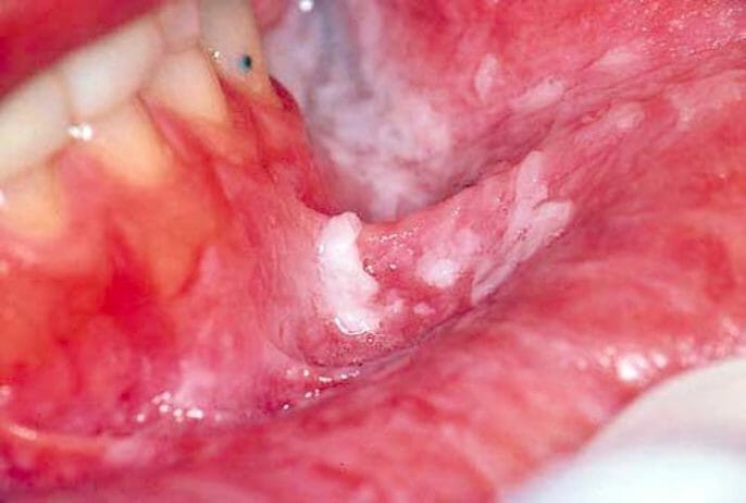 Peeling de revestimiento de la mucosa oral