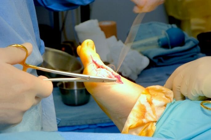 Eliminación de Juanetes (Bunionectomía): Preparación para la cirugía y la recuperación post operatoria