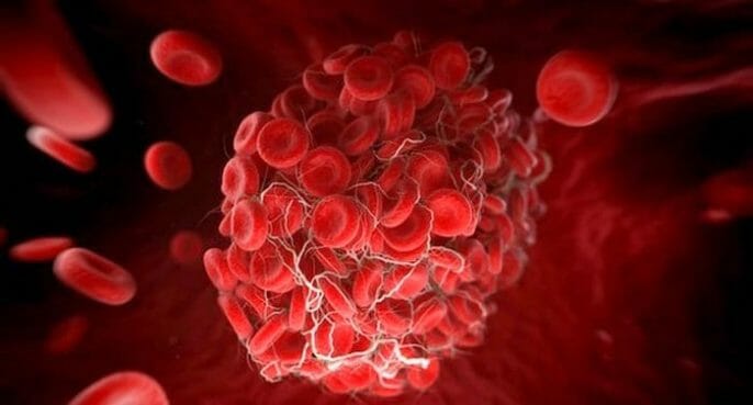 FIV aumenta el riesgo de coágulos de sangre en el primer trimestre