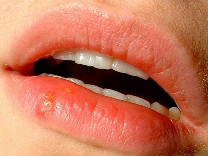 Las infecciones agudas de la boca que causan la fiebre, el dolor de garganta y encías inflamadas