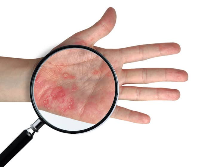¿Qué causa la dermatitis de la mano?