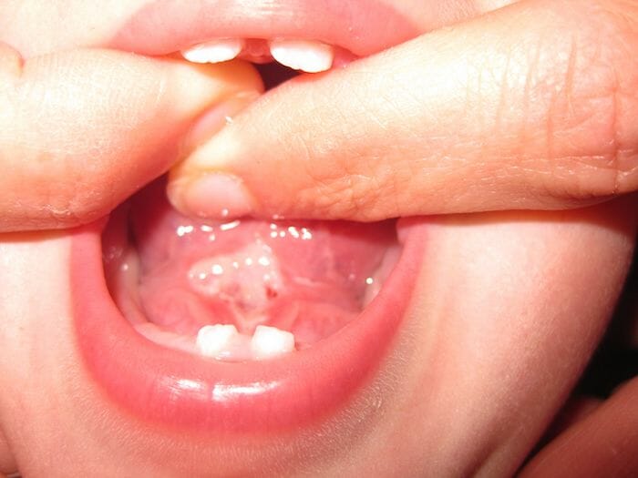 Inflamación dolorosa bajo la lengua: ¿por qué?