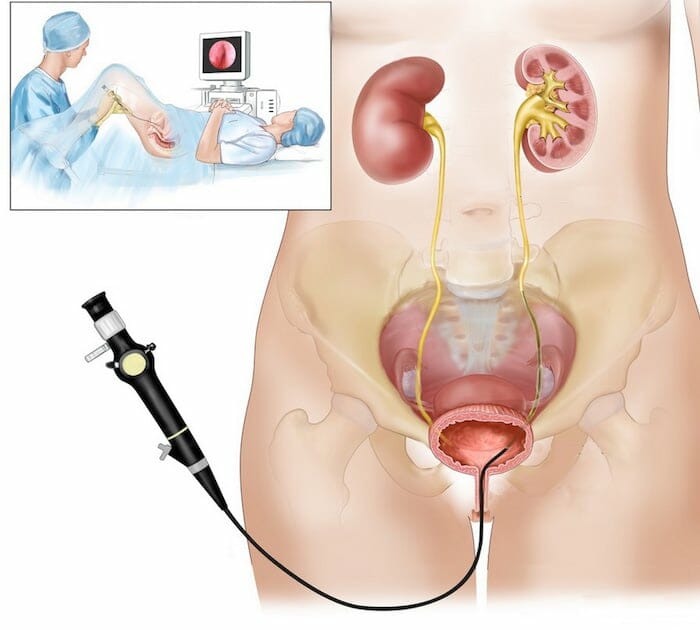 Dolor en la uretra: causas y factores de riesgo