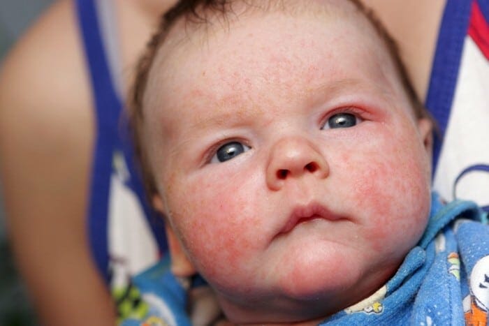 Alergia a la leche en lactantes y niños pequeños