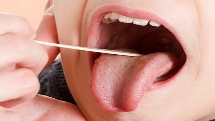 ¿Qué causa el dolor de garganta?
