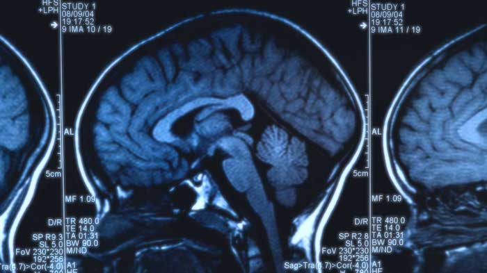 Tumor cerebral pineal: perspectiva del paciente