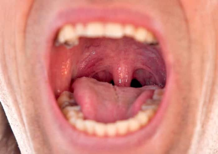 Sensación ardiente en la boca después de la terapia del cáncer: opciones médicas y alternativas del tratamiento