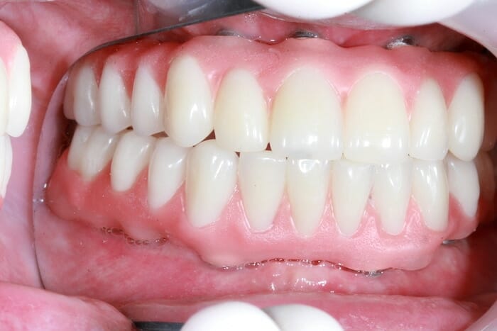 Reemplazo permanente del diente para personas que no tienen dientes: implantes dentales versus dentaduras