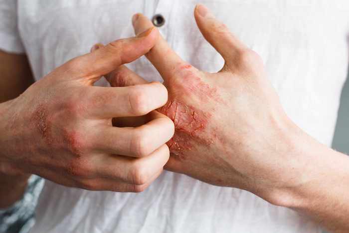 La manteca de karité africana para el eczema: ¿un tratamiento natural para la dermatitis atópica?