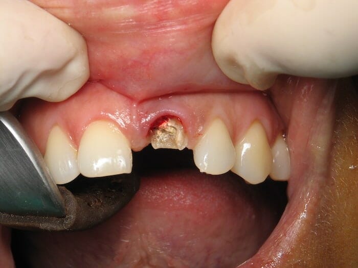 ¿Está usted perdiendo un diente? 3 mejores métodos para el reemplazo permanente del diente