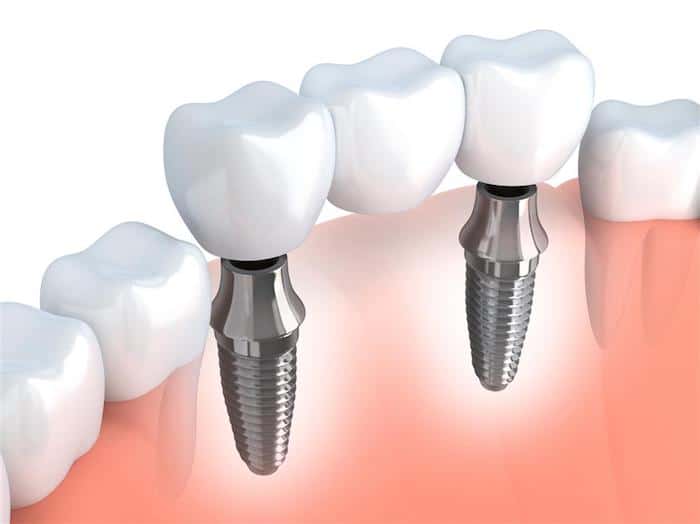Reemplazo permanente de dientes con implantes dentales: tipos, procedimientos, recuperación y postratamiento