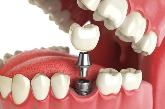 Puentes, coronas e implantes: reemplazo permanente del diente en pacientes con enfermedad cardíaca