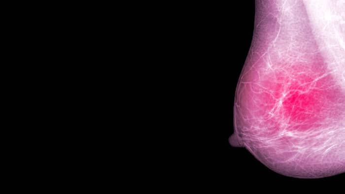 Cómo detectar el cáncer de mama en las primeras etapas