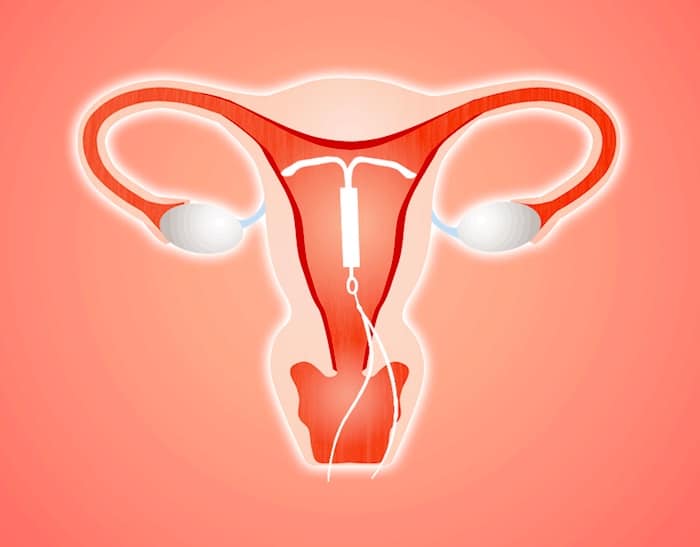 ¿Puede el DIU Mirena causar infertilidad?