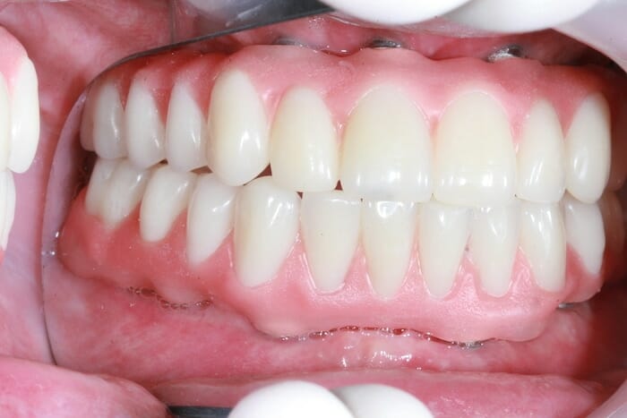 ¿Qué tipo de dentista consultar para el reemplazo permanente del diente?