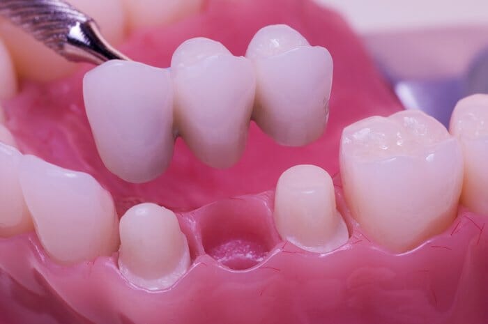 Reemplazo permanente del diente: diferentes técnicas utilizadas para puentes dentales