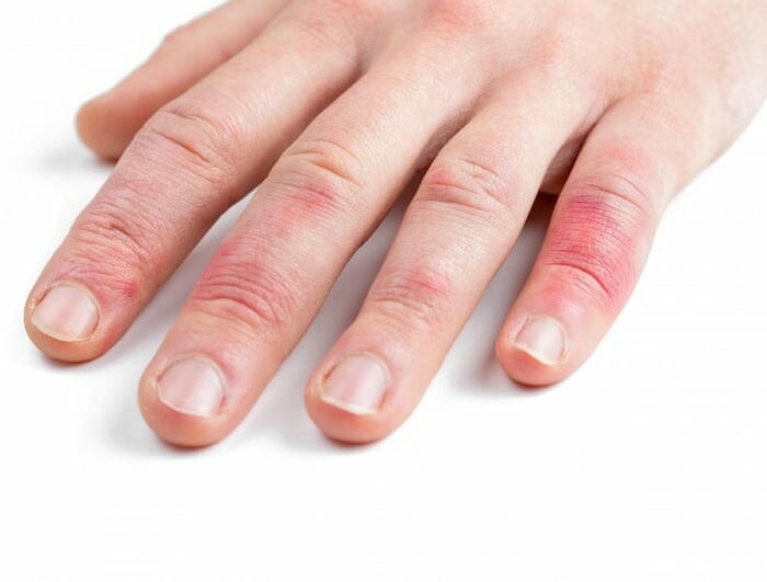 ¿Qué causa los dedos hinchados y con picazón?