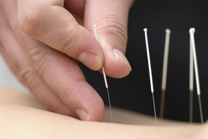 ¿La acupuntura puede ayudar a controlar el dolor?