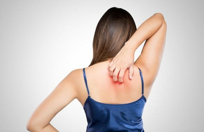 Notalgia parestésica: ¿picazón en la parte superior de la espalda sin una causa obvia?