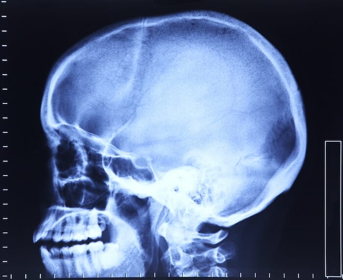 ¿Qué causa las abolladuras en el cráneo? ¿Y qué puedes hacer al respecto?